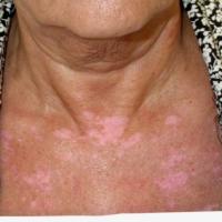 
	Vitiligo and myaesthenia gravis 