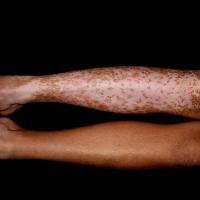 
	Vitiligo - segmental

	Copied with kind…