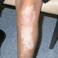 
	Vitiligo: pre-treatment

	Left leg affected…