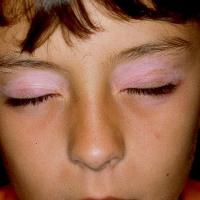 
	Vitiligo - eyelids

	Copied with kind…