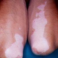 
	Vitiligo - forearms 