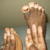 
	Vitiligo 
	
	The extremities are a commonly…
