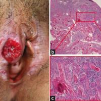 
	SCC - clinical and histopathological…