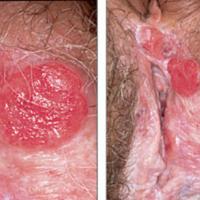
	Squamous cell carcinoma secondary to lichen…