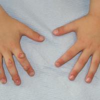 
	Common warts