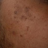 
	Plane warts&nbsp;