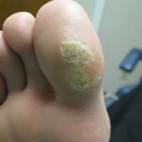 
	Mosaic plantar warts