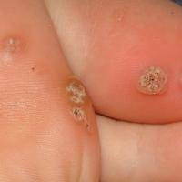 
	Plantar warts

	Copied with kind permission…