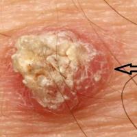 Cutaneous squamous cell carcinomaThe red flag was…