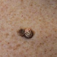 A verrucous keratosis&nbsp;This is where a viral…