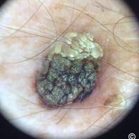 Dermoscopic appearance of previous figure