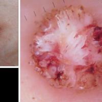Filiform wart