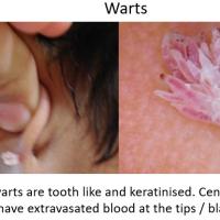 Filiform wart