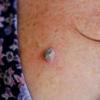 WartOccasionally, warts can have a similar…