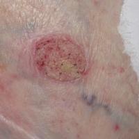 WartThe main differentials were Bowen's disease…