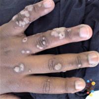 Common warts
Copied with kind permission from…