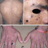 
	Epidermodysplasia verruciformis

	(A)…