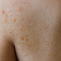 
	Xanthoma disseminatum