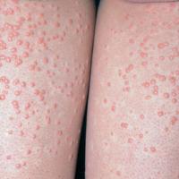 
	Eruptive xanthomata