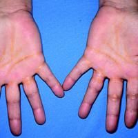 
	Palmar xanthomata
