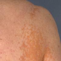
	Plane xanthomata