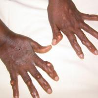 
	Tendon xanthomata