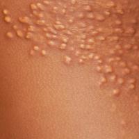 
	Eruptive xanthomata
