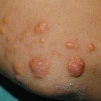 
	Tuberous xanthomata

	Copied with kind…