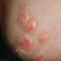 
	Tuberous xanthomata

	Copied with kind…