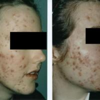 Acne grading - face, grade 7+8