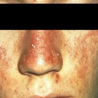Photosensitivity from doxycycline
Copied with…