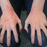 
	Isotretinoin and dry skin 

	Isotretinoin…