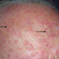 Thin actinic keratoses with field changeThe whole…