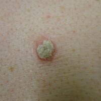 Actinic keratosisSuitable for treatment with…