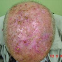Severe actinic damageThis patient should be…