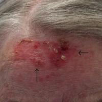 Actinic keratoses with field change on the right…