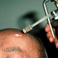 
	Actinic keratosis treated with cryotherapy