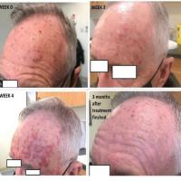 A standard course of treatment with 5% 5-FU cream