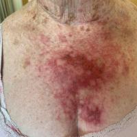 A 'good' reaction to 5% 5-FU cream OD 4…
