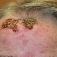 Same patient as previous figure after four weeks…