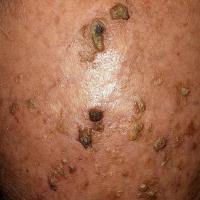 Severe actinic damageMost such patients are best…
