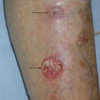 Bowen's disease - two lesions suitable for…