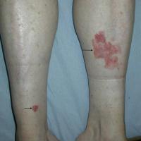 
	Bowen's disease - multiple lesions and…