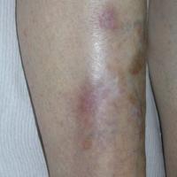
	Bowen's disease - figure 1…