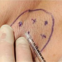 
	Botox injection for hyperhidrosis of the axillae