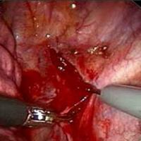 
	ETS for hyperhidrosis of the palms