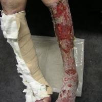 
	Contact allergic dermatitis to…