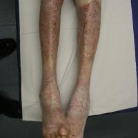 
	The same patient as previous image - ten days…