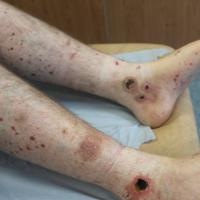 
	Cutaneous small vessel vasculitis 