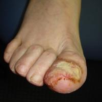 
	SCC of toe - treated as an ulcer for four years